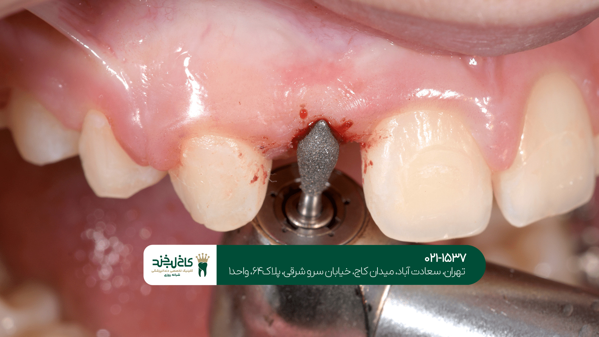 جدیدترین متد کاشت دندان