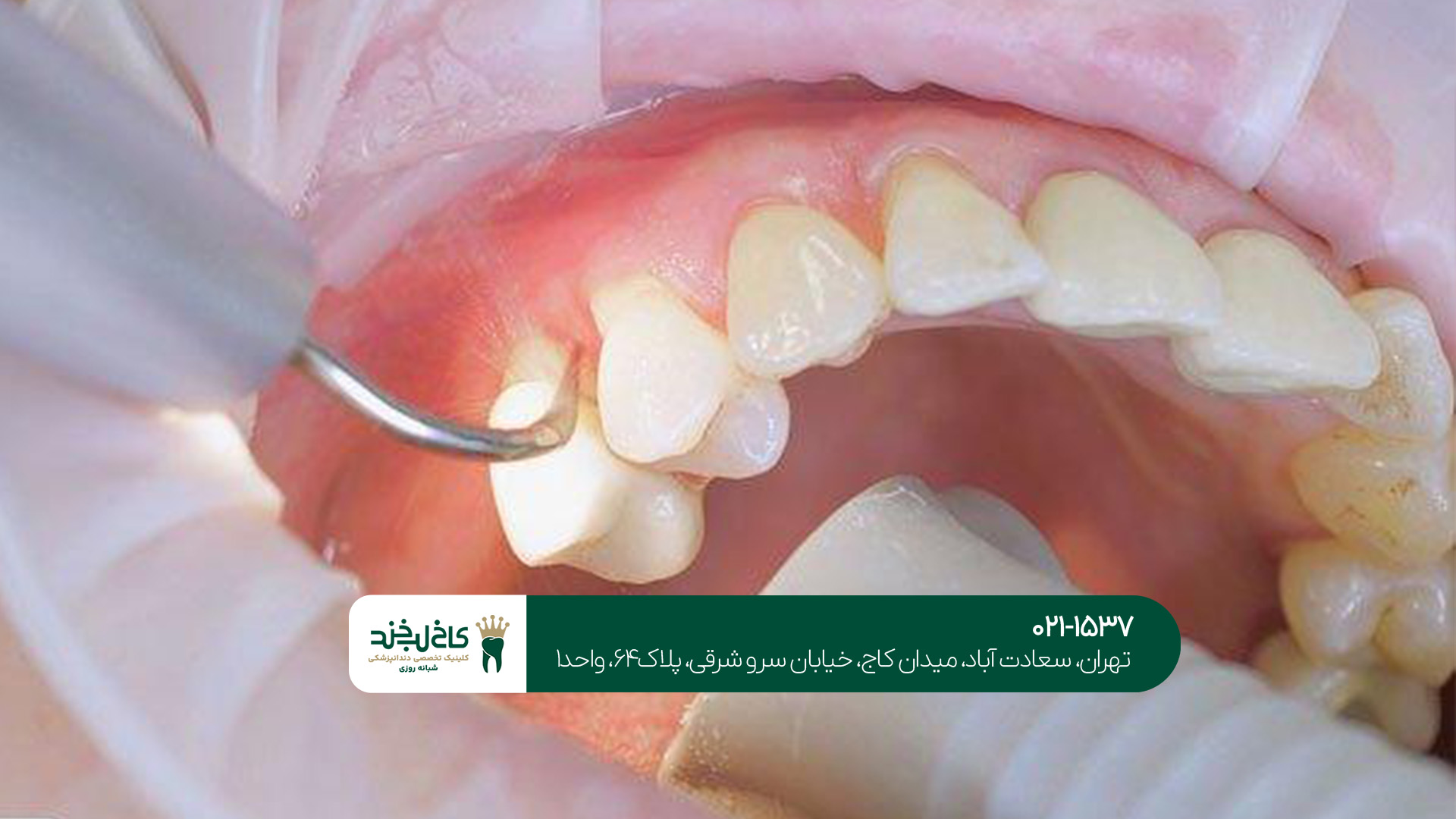 هزینه درمان ریشه دیجیتال هزینه درمان ریشه دیجیتال