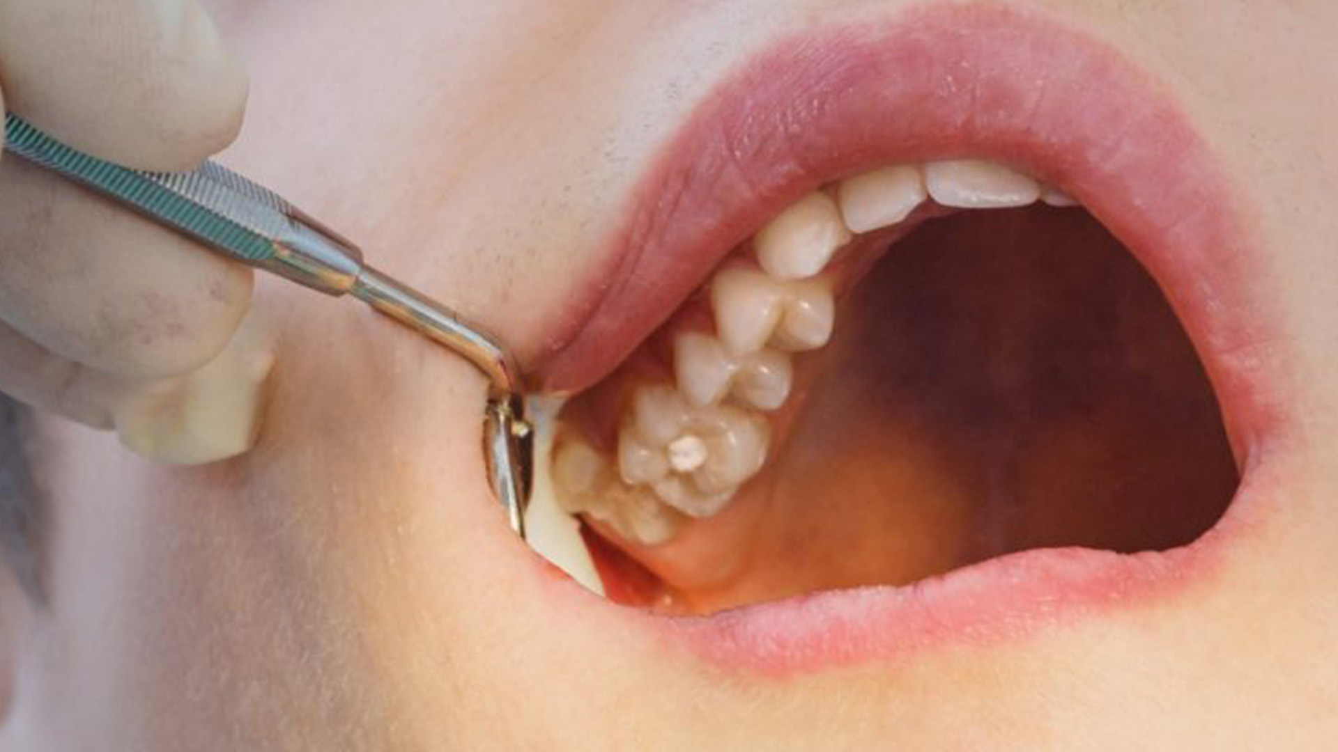 پر کردن دندان بدون درد پر کردن دندان بدون درد