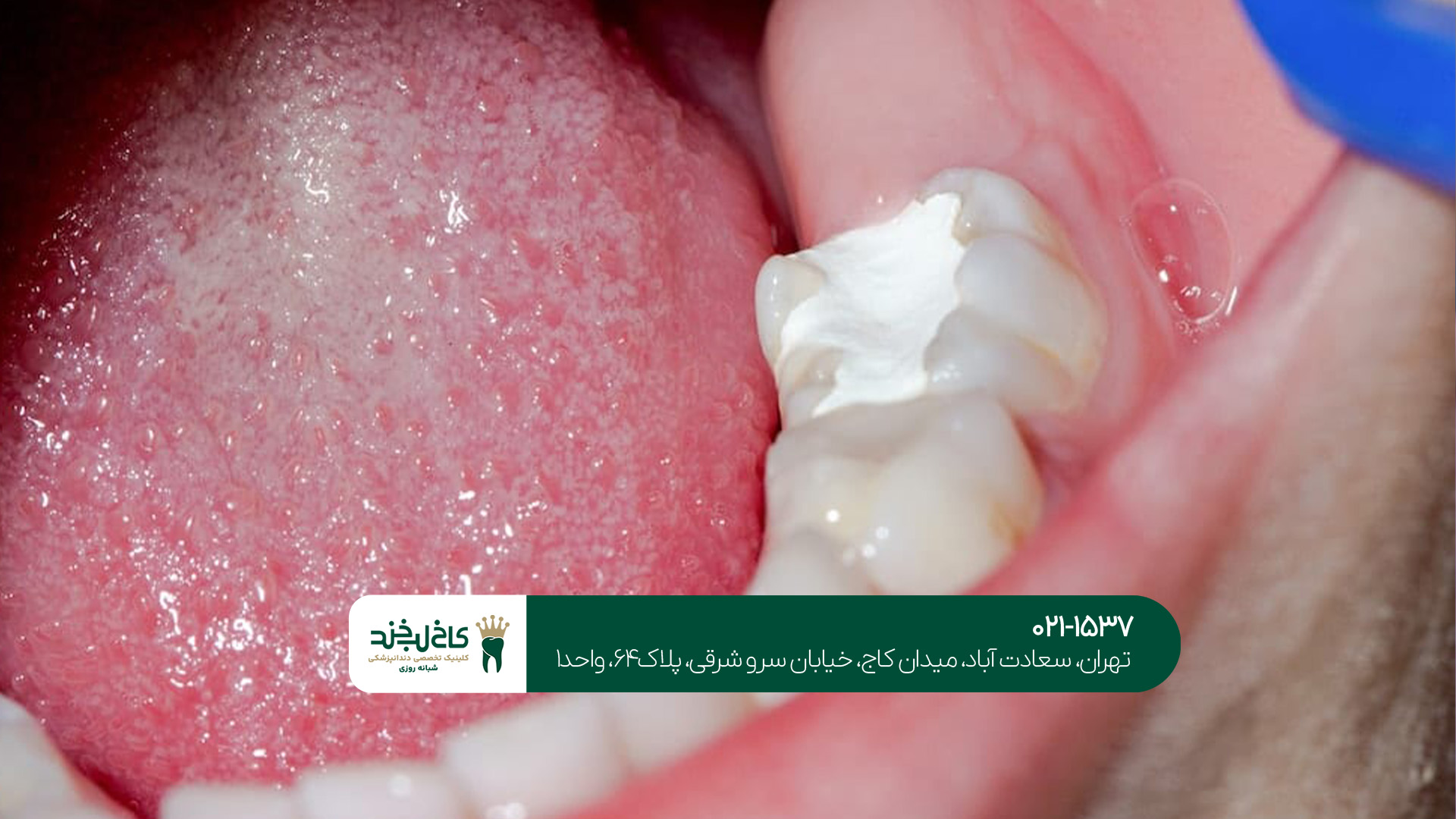 پر کردن دندان بدون درد پر کردن دندان بدون درد