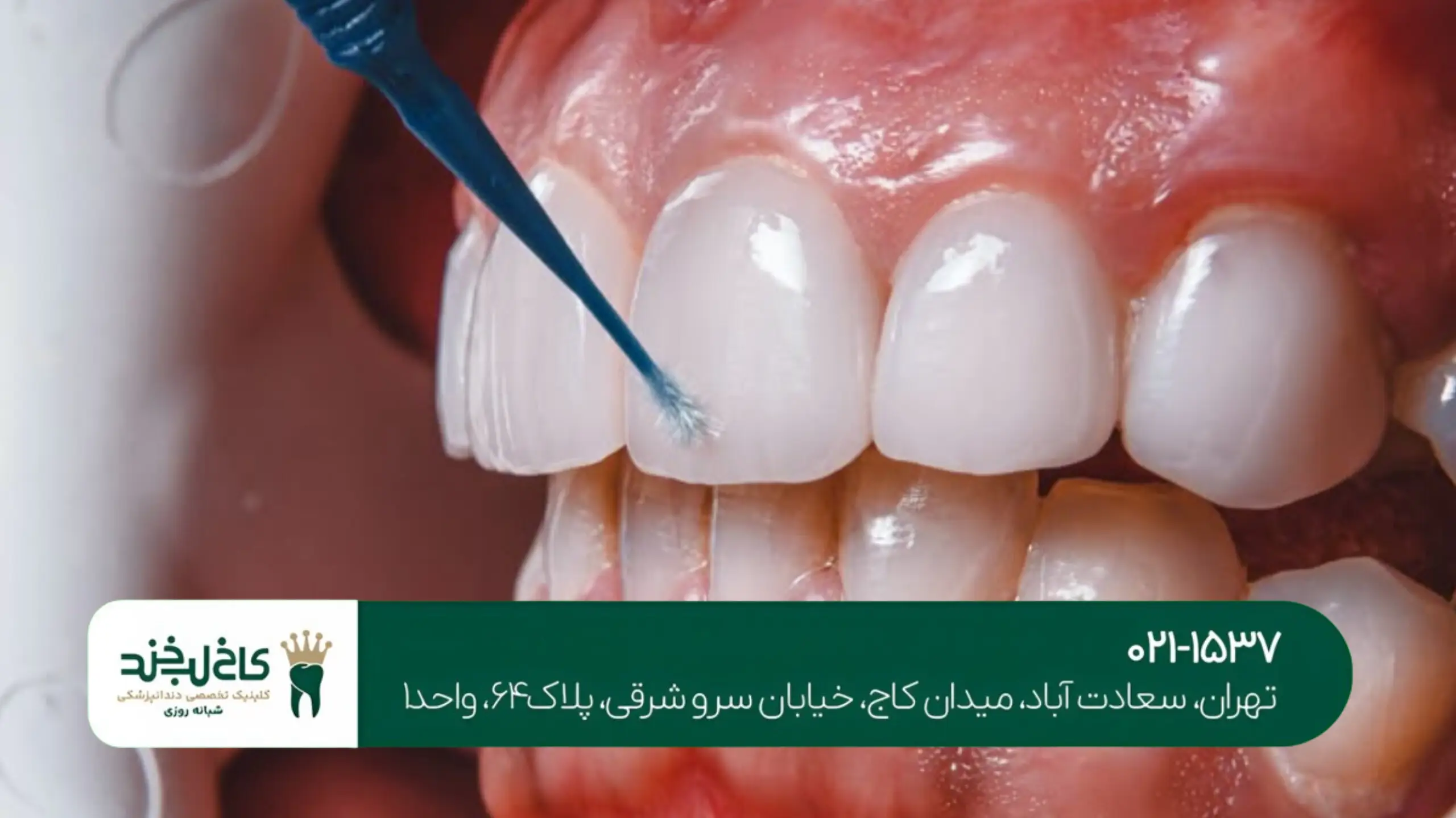 لمینت فوق شفاف تهران