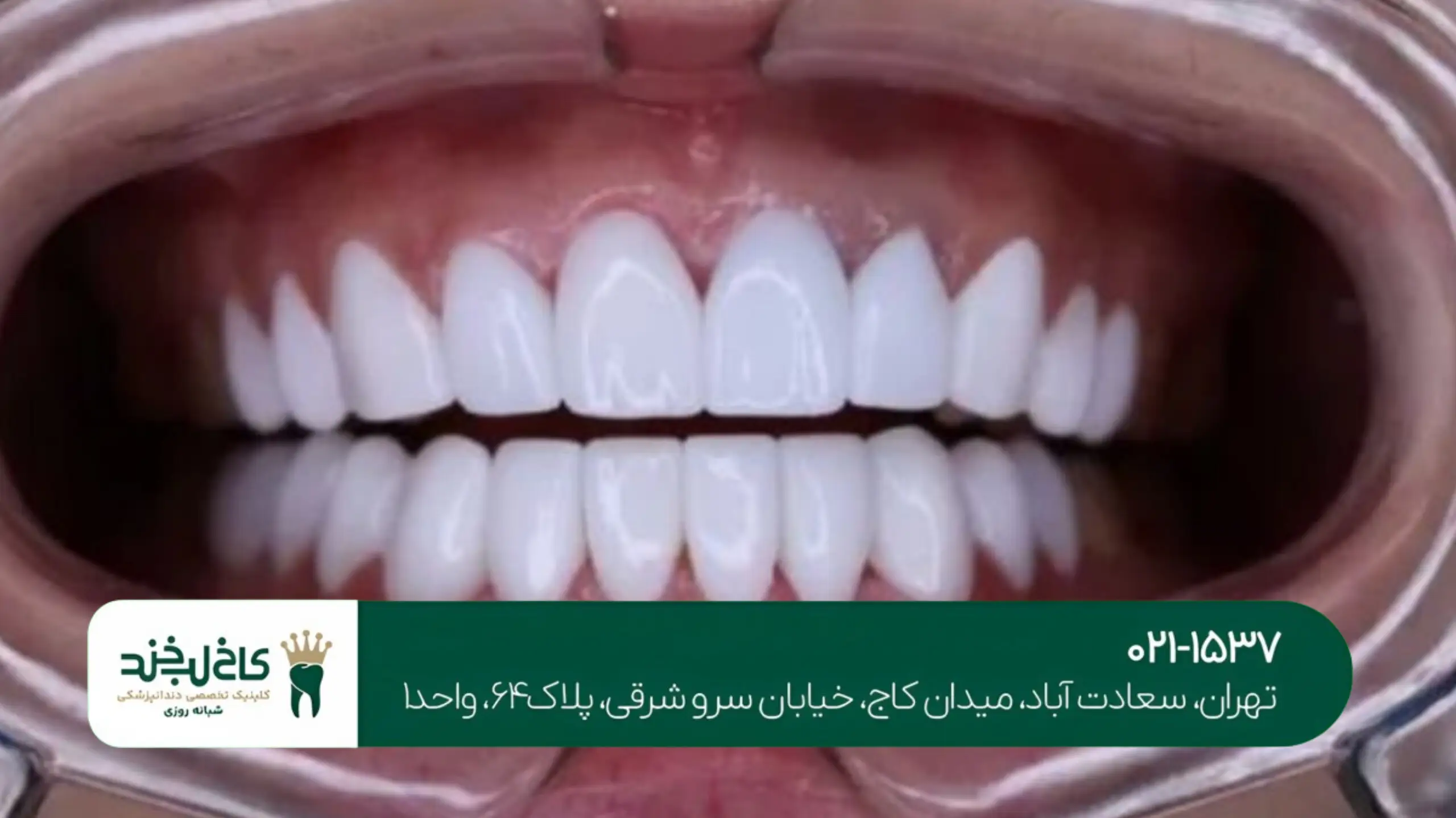 لمینت فوق شفاف تهران