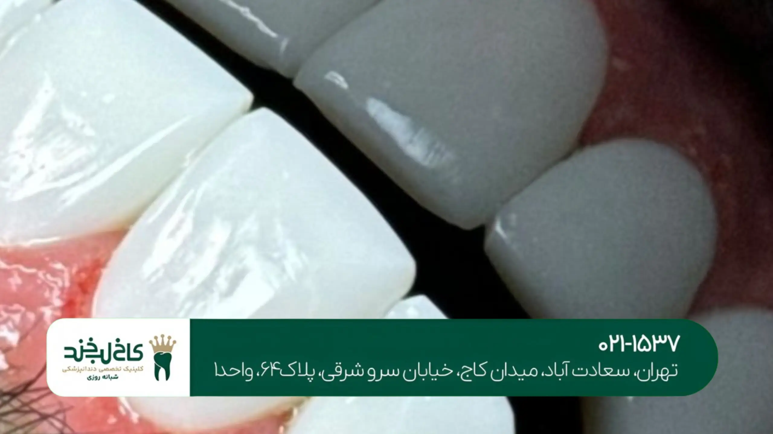 لمینت فوق شفاف تهران