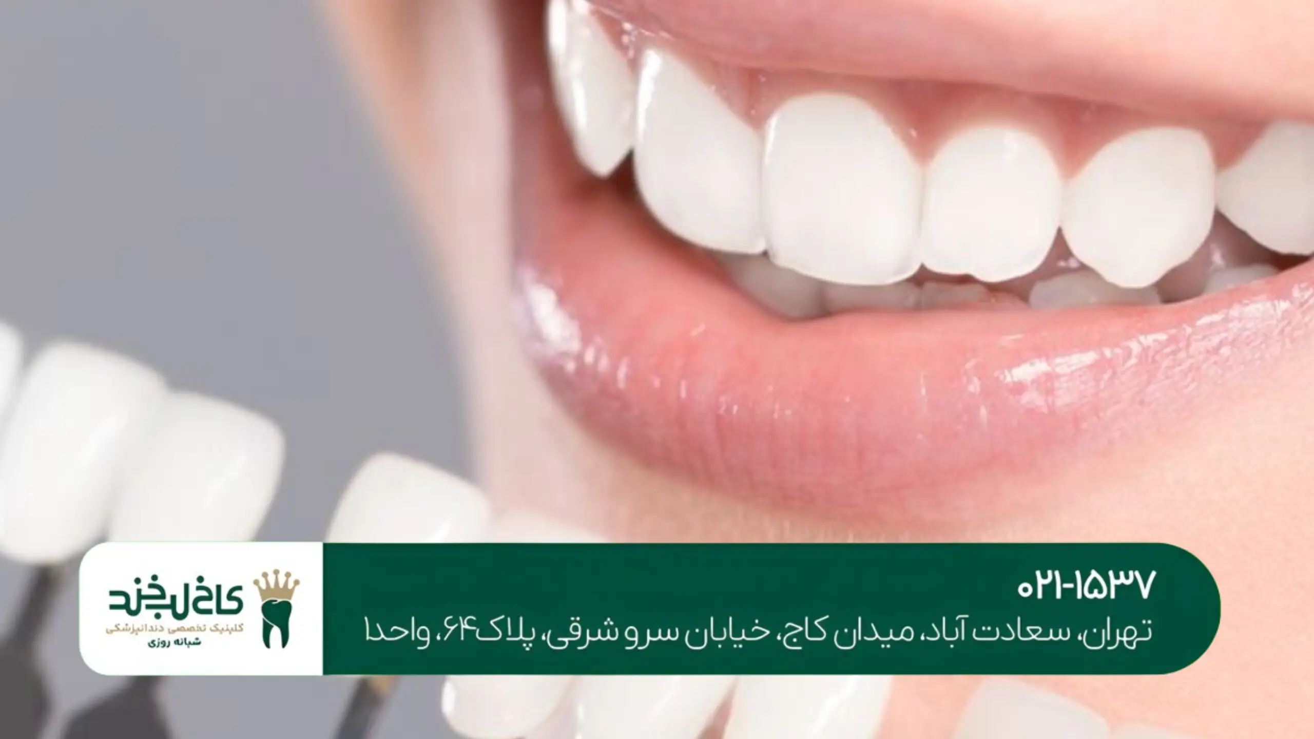 لمینت مناسب چه افرادی است؟