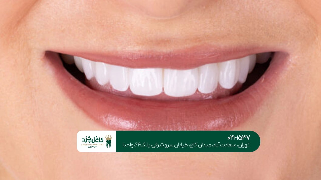 مشاوره اصلاح طرح لبخند