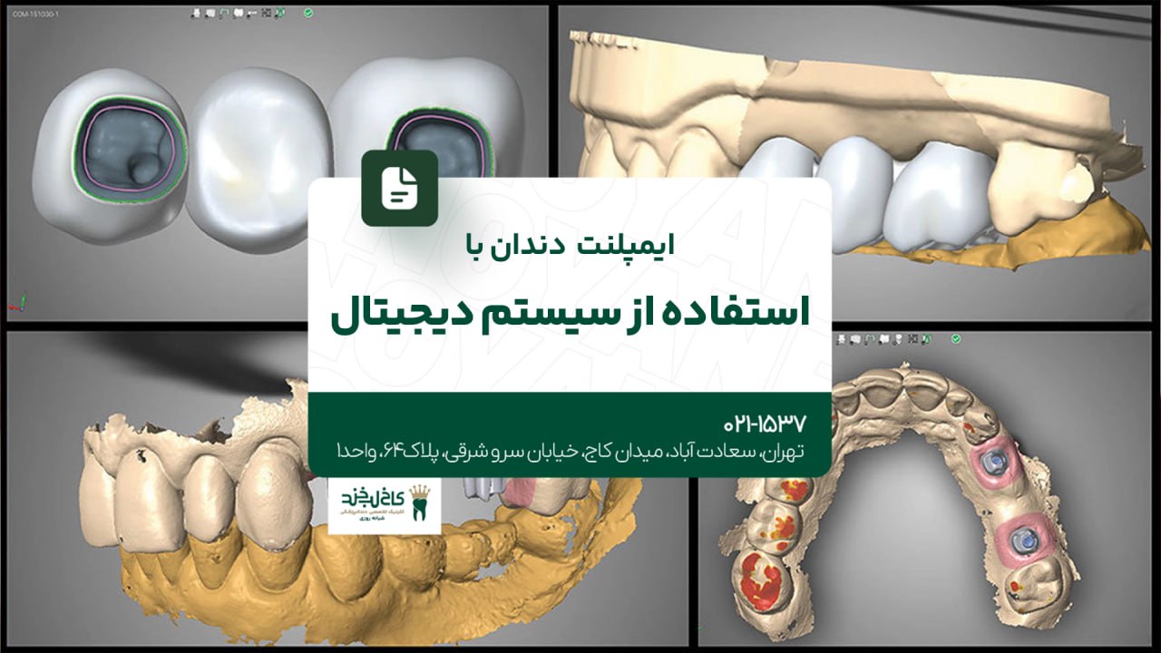 ایمپلنت دندان با استفاده از سیستم دیجیتال