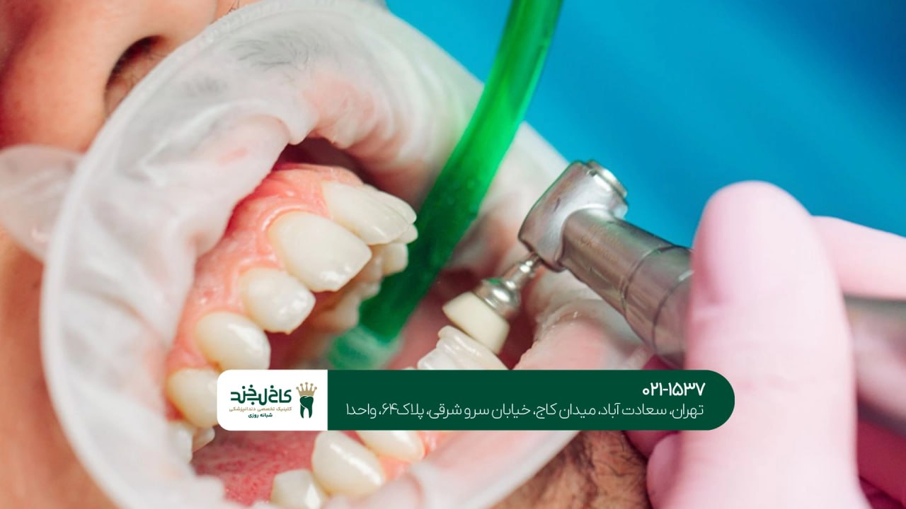 جرمگیری و پولیش دندان در تهران