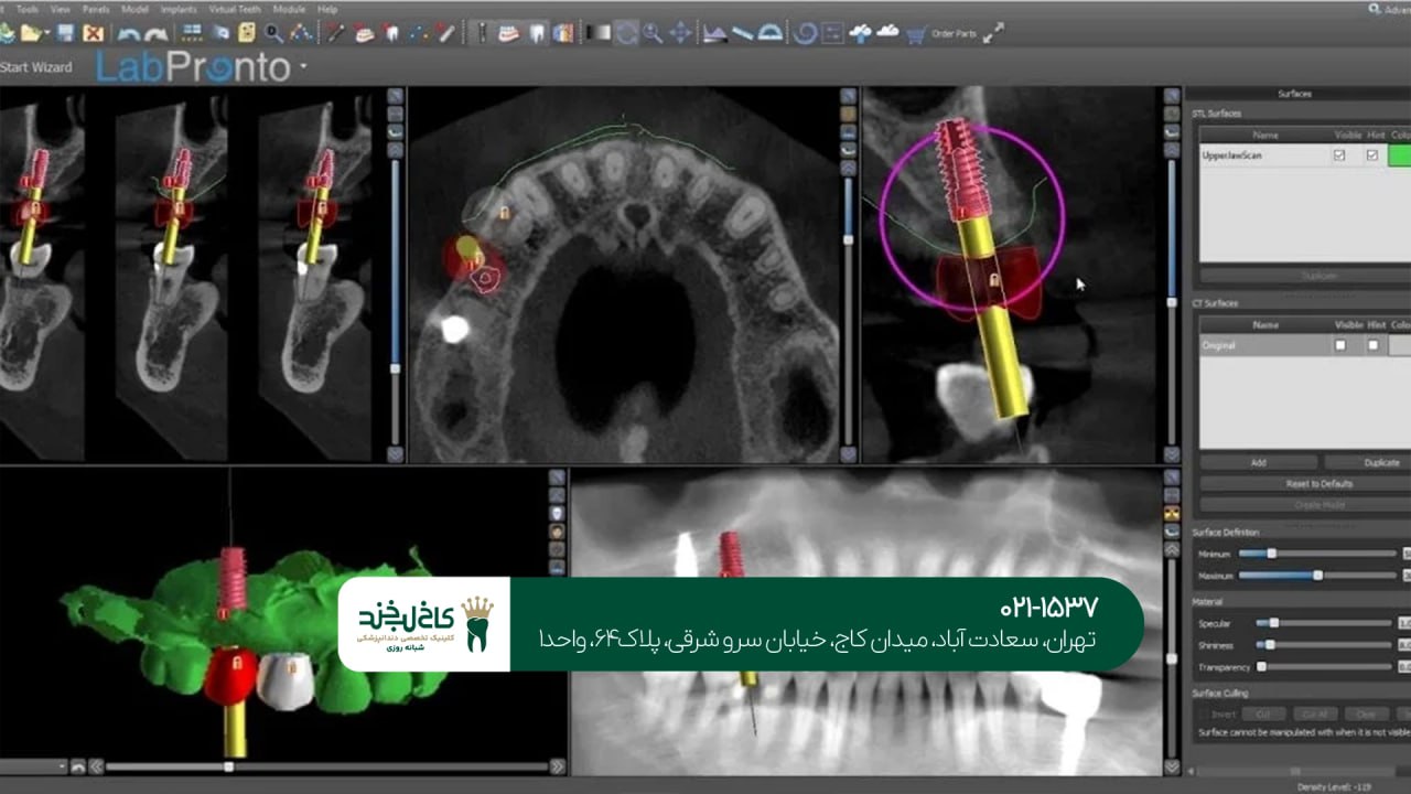 ایمپلنت دندان با استفاده از سیستم دیجیتال