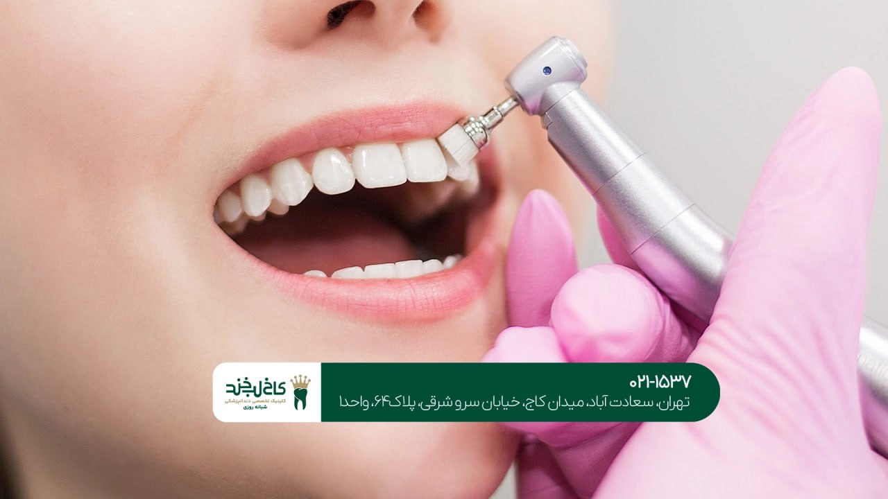 جرمگیری و پولیش دندان در تهران