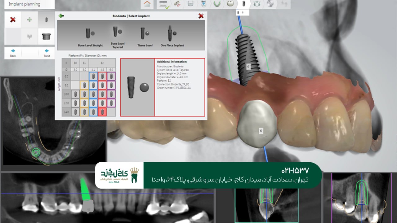 ایمپلنت دندان با استفاده از سیستم دیجیتال