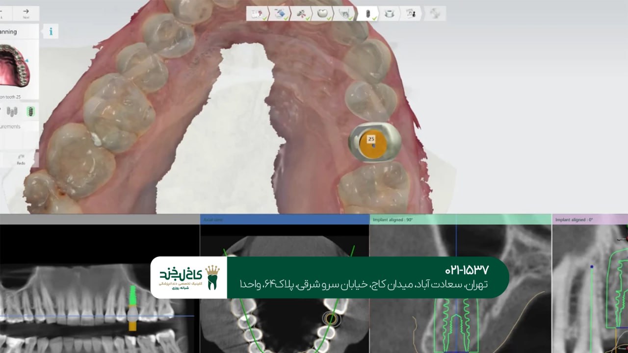 ایمپلنت دندان با استفاده از سیستم دیجیتال