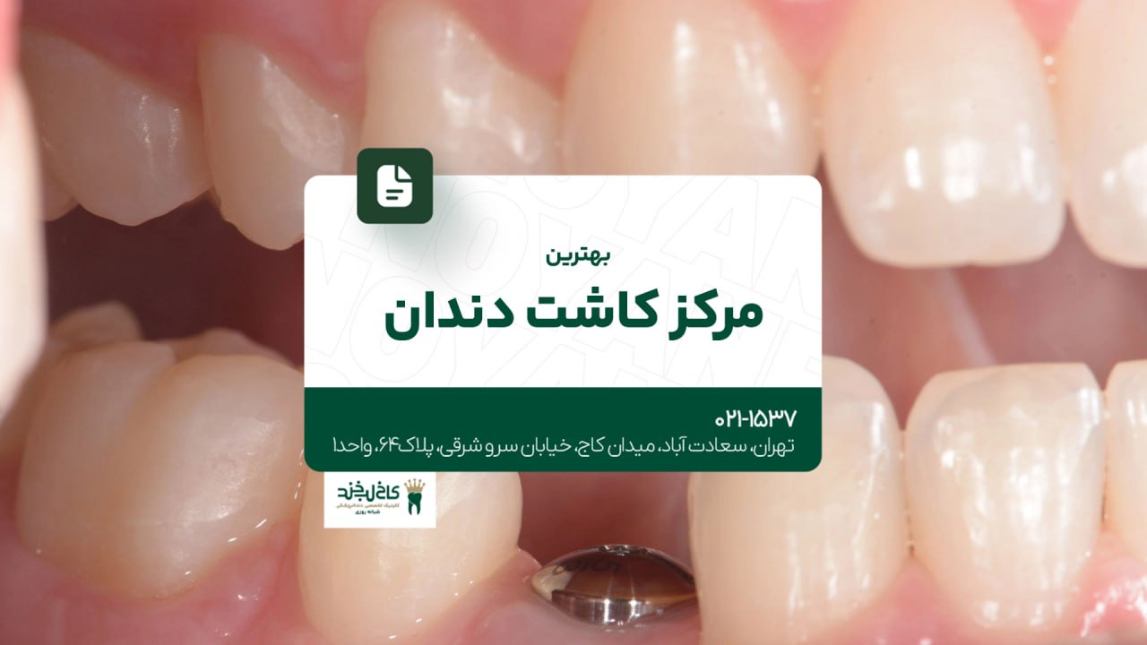 بهترین مرکز کاشت دندان