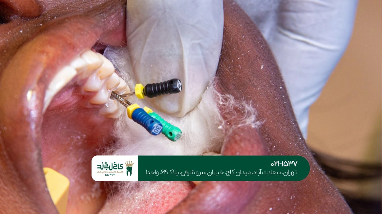 درمان ریشه دندان