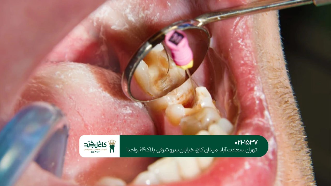 درمان ریشه دندان