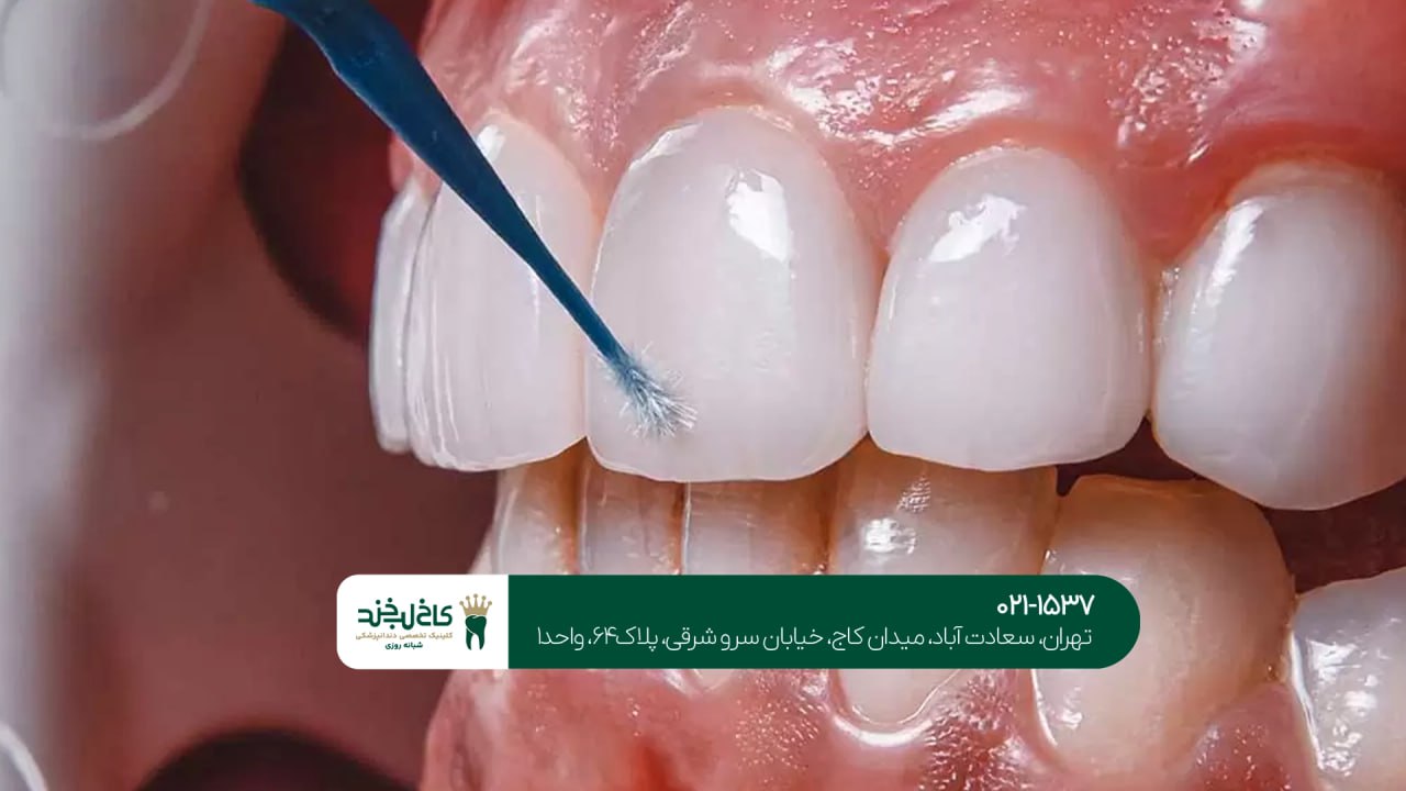 لمینت دندان طبیعی در تهران
