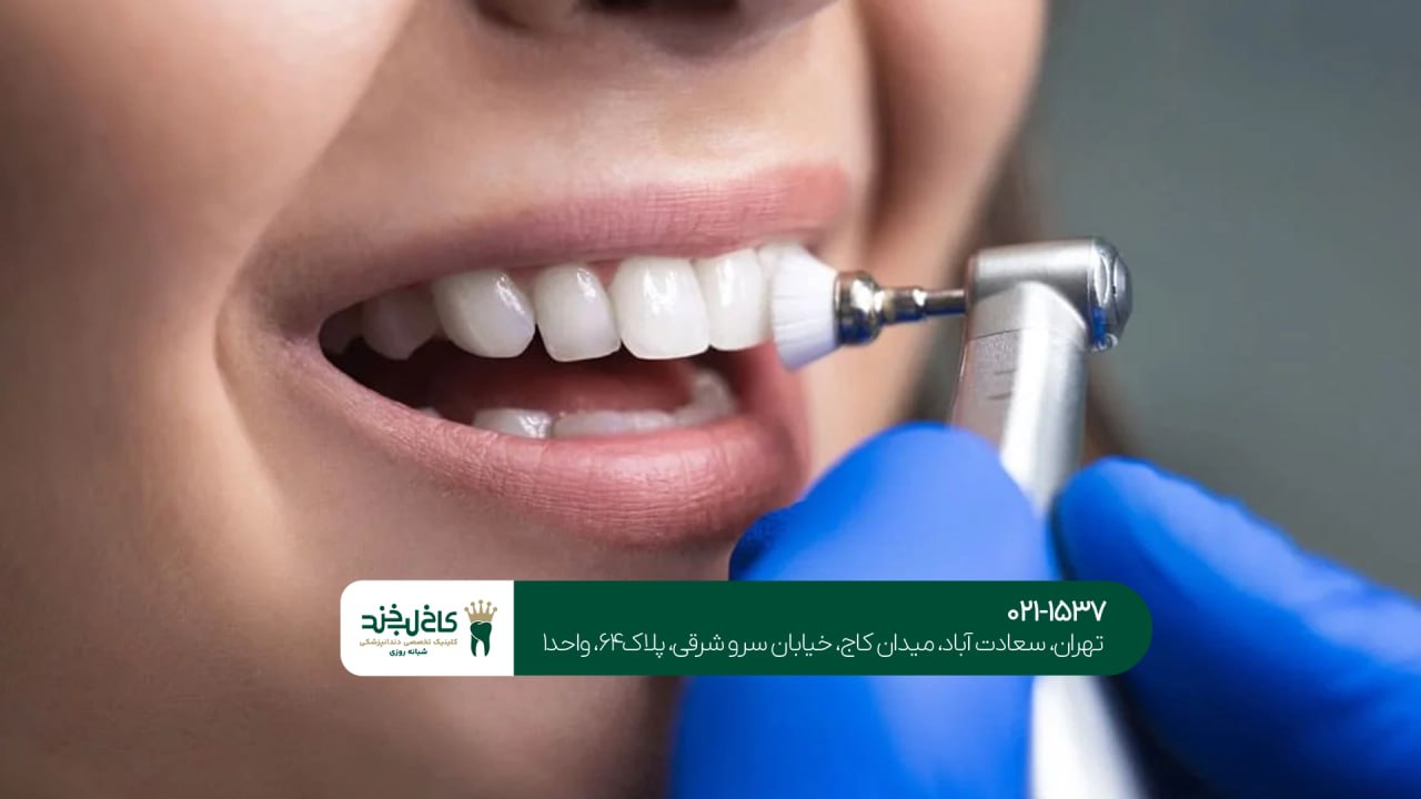 بلیچینگ حرفهای تهران