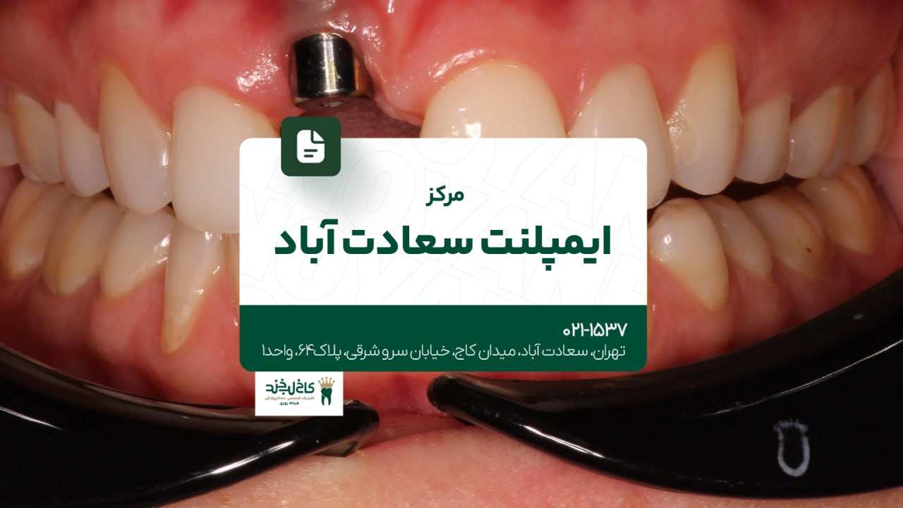 مرکز ایمپلنت سعادت آباد
