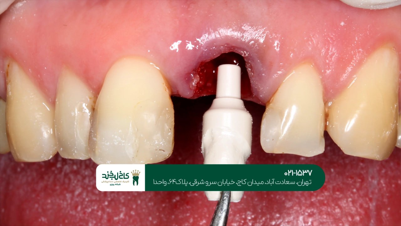ایمپلنت همراه روکش زیرکونیا