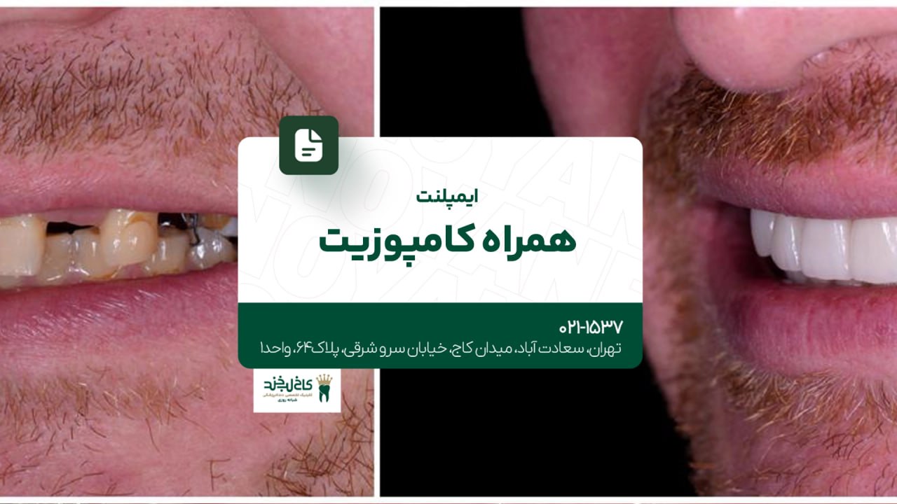 ایمپلنت همراه کامپوزیت