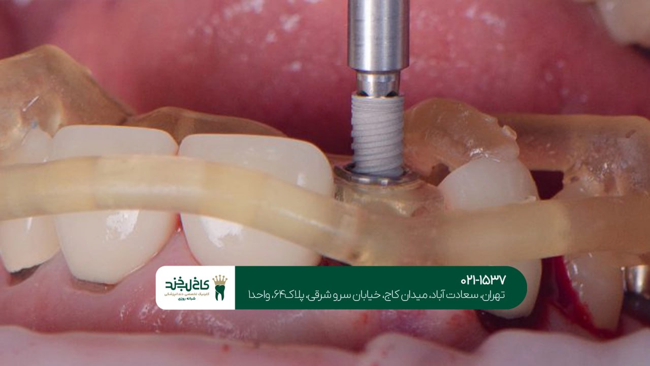 جراحی دیجیتال ایمپلنت