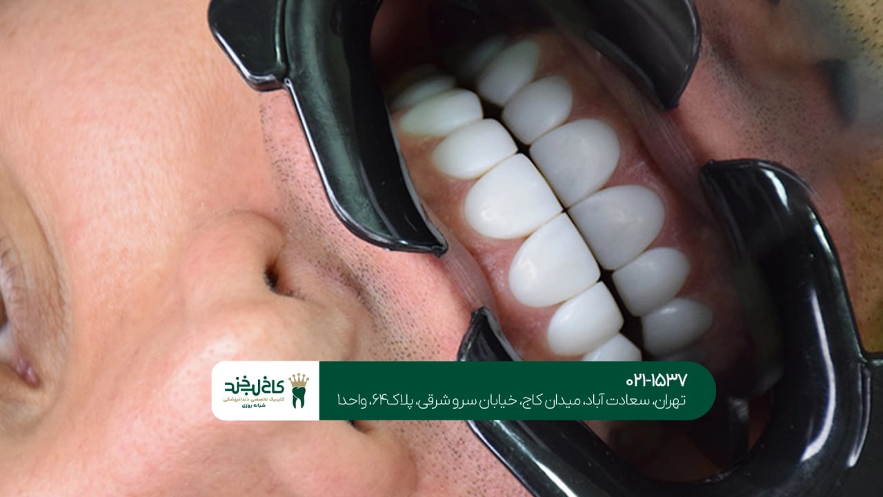 کلینیک لمینت حرفهای تهران