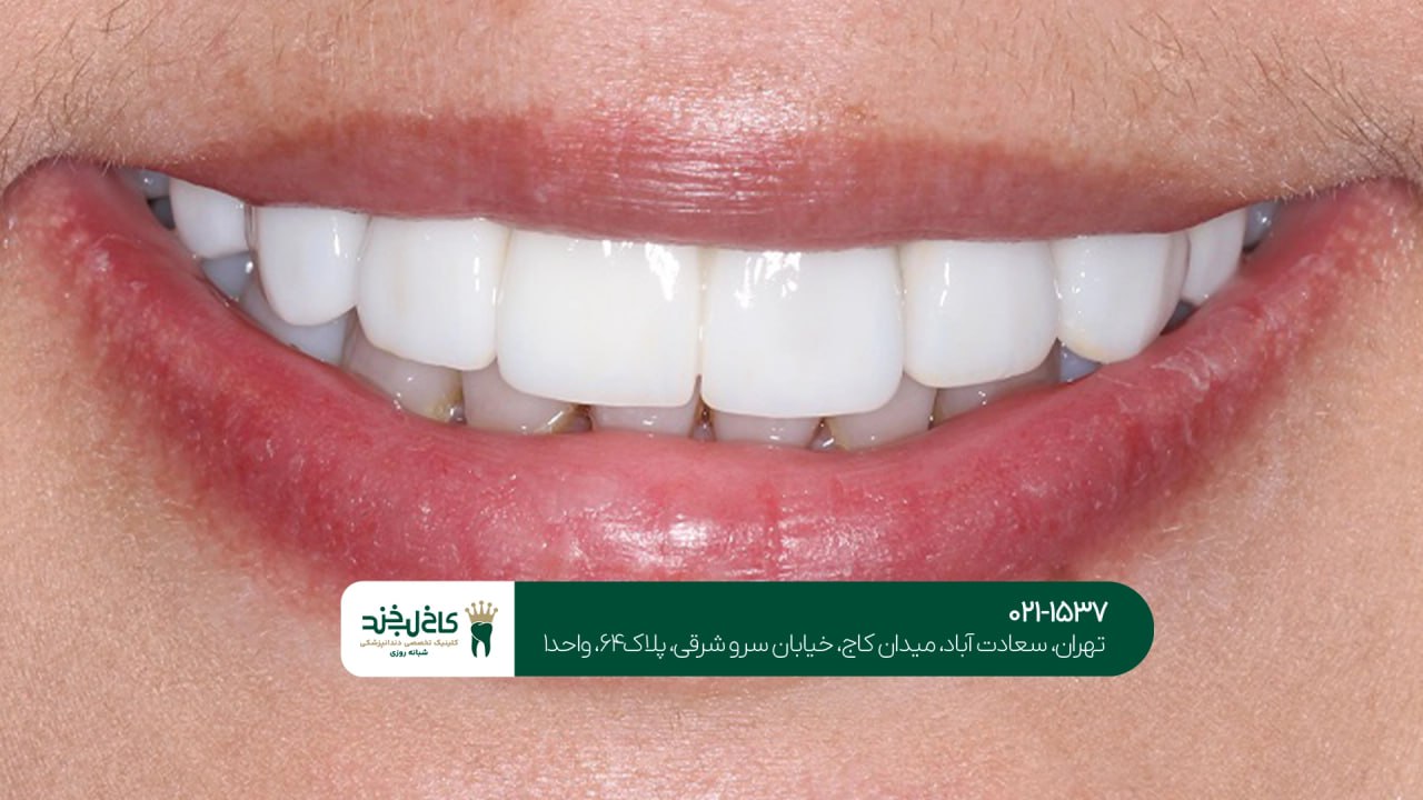 لمینت سرامیکی