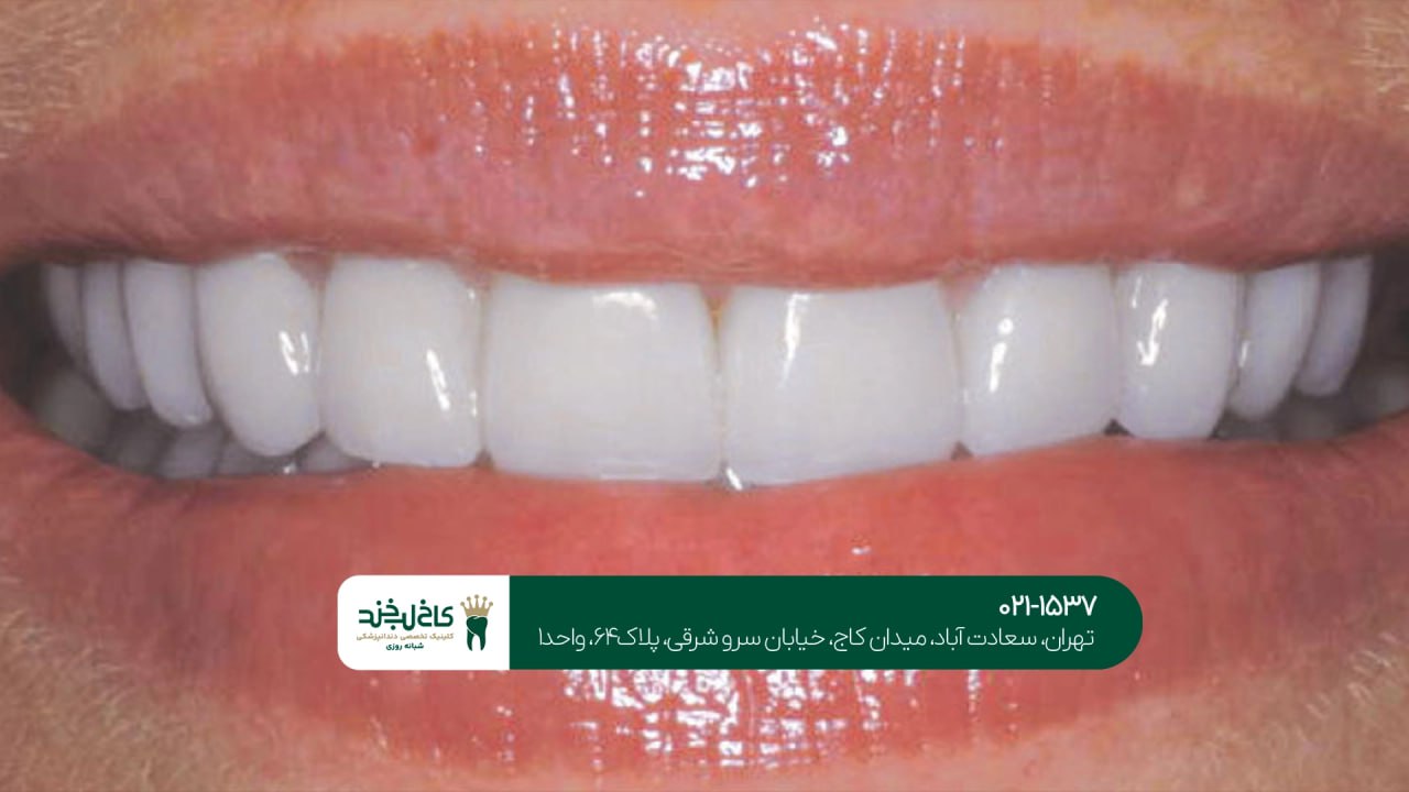 کامپوزیت با ماندگاری بالا