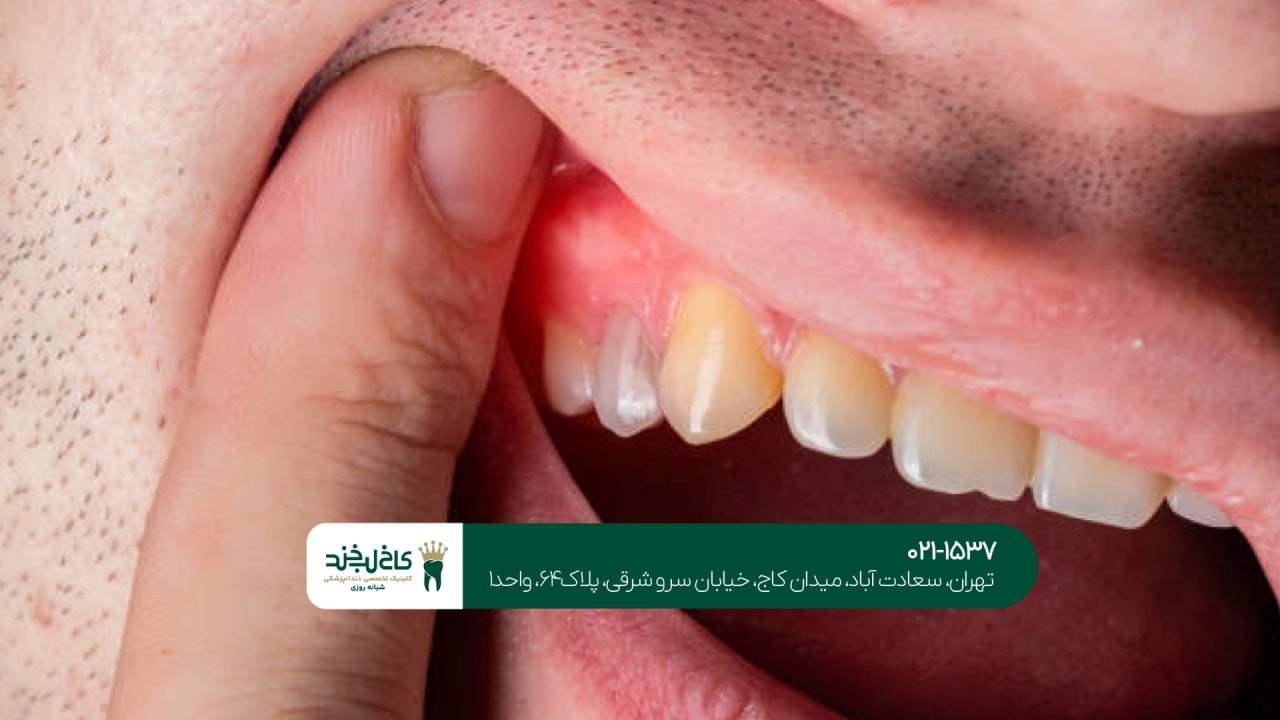 درمان بیماریهای لثه