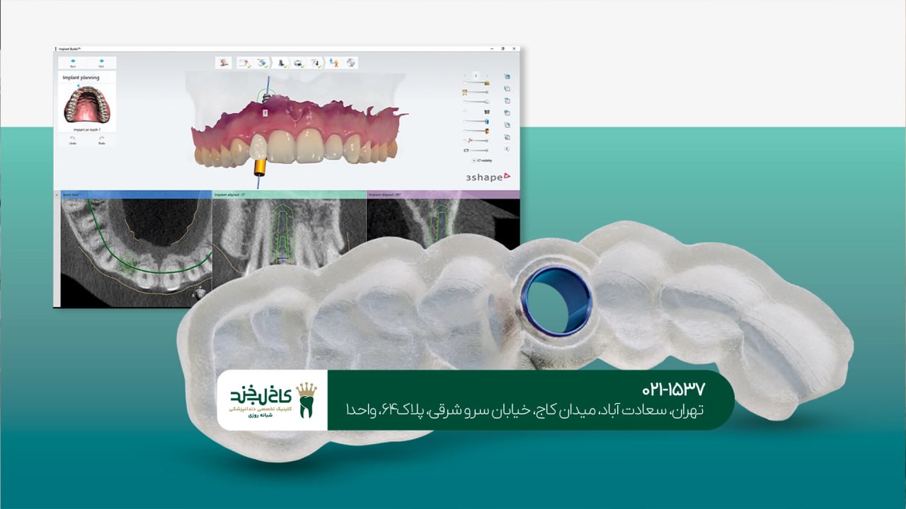 ایمپلنت دیجیتال بدون جراحی