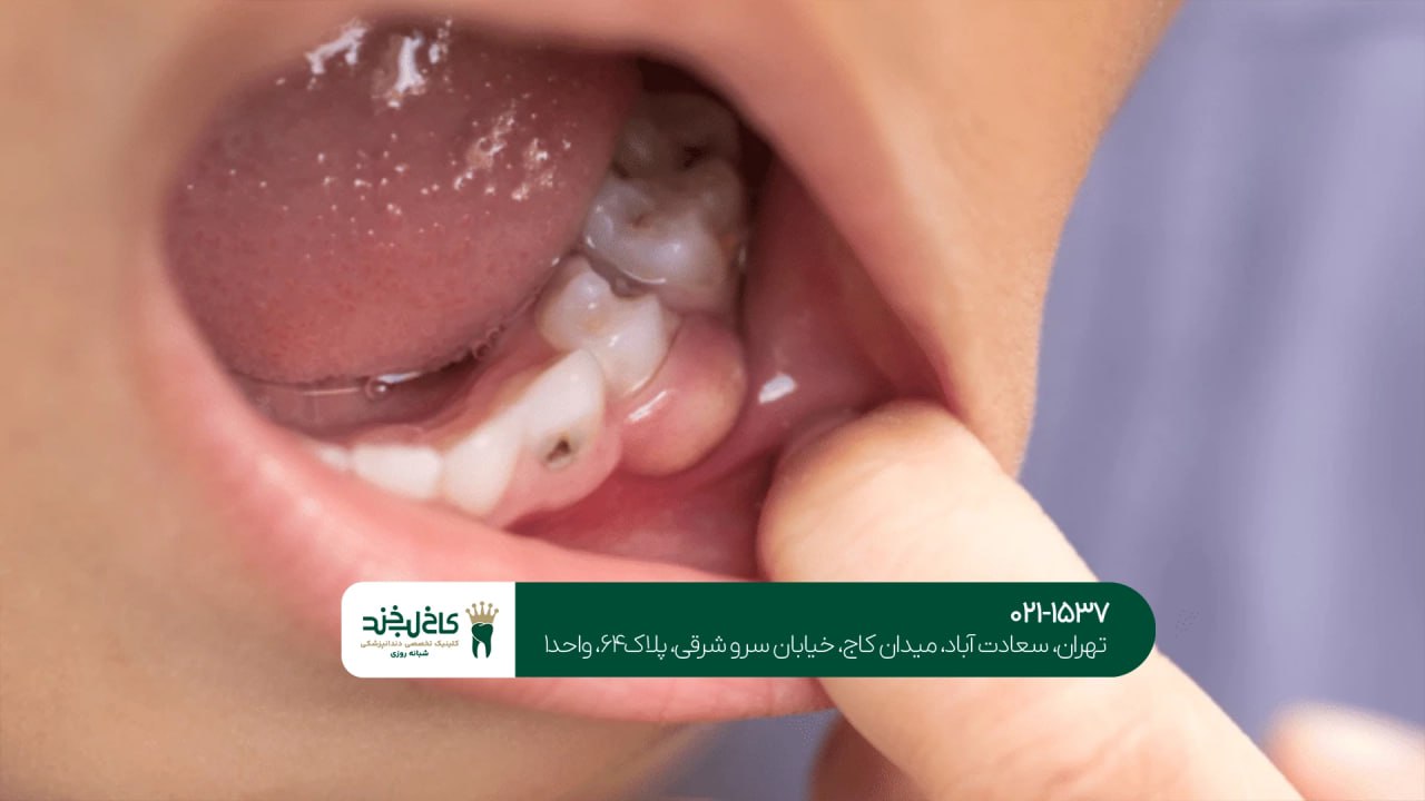 درمانهای ضد عفونی دهان و دندان