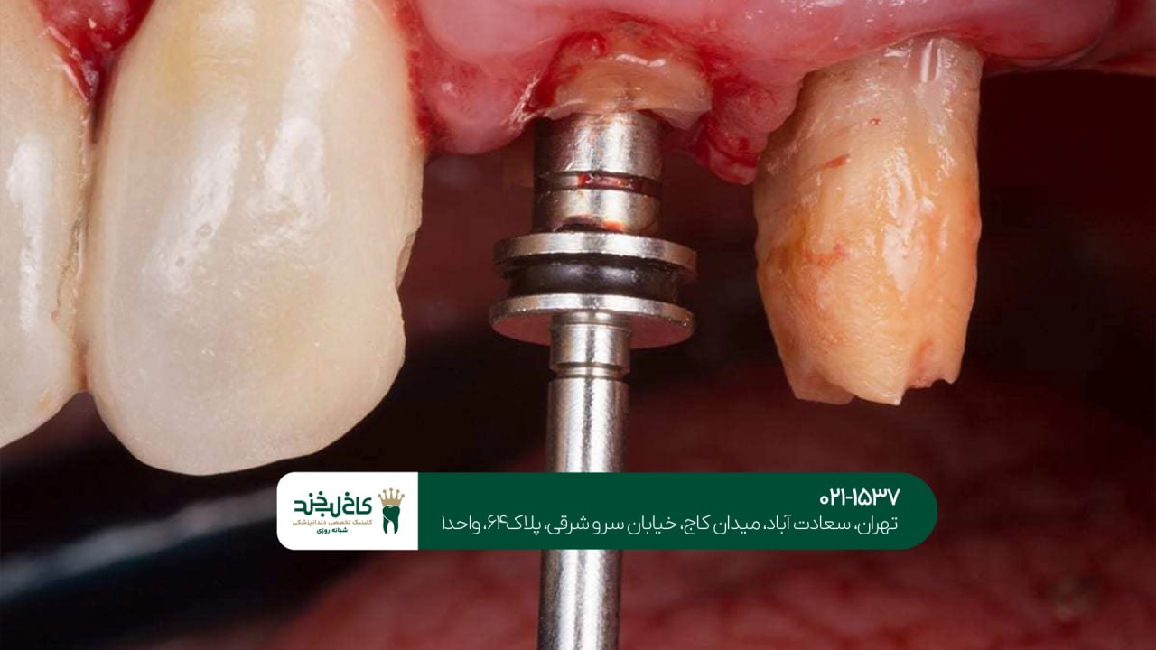 درمانهای تخصصی ایمپلنت