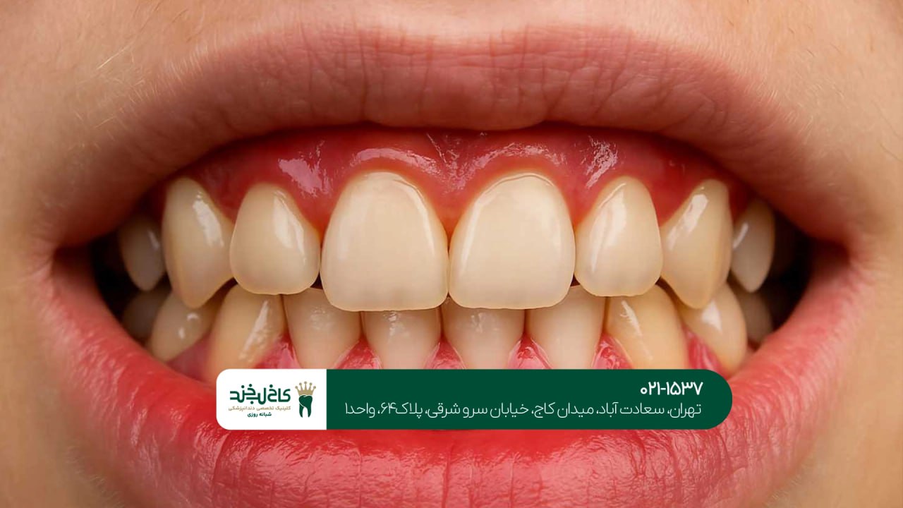 درمان لثه در تهران