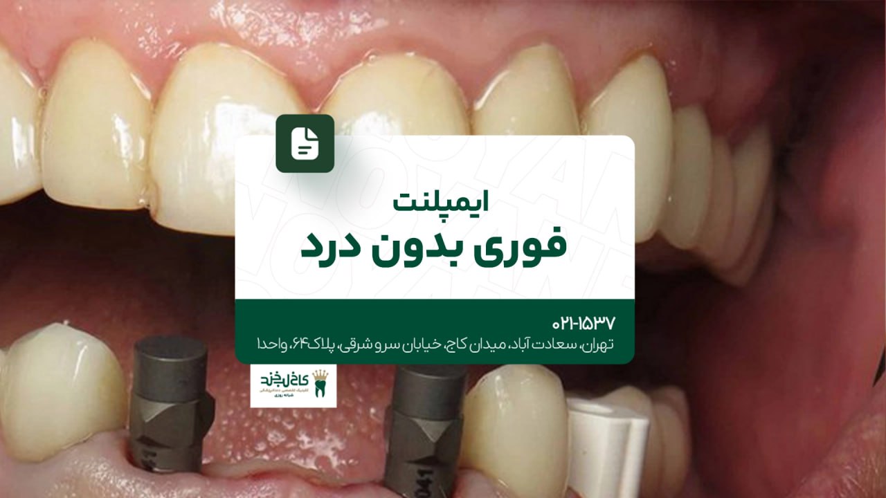 ایمپلنت فوری بدون درد