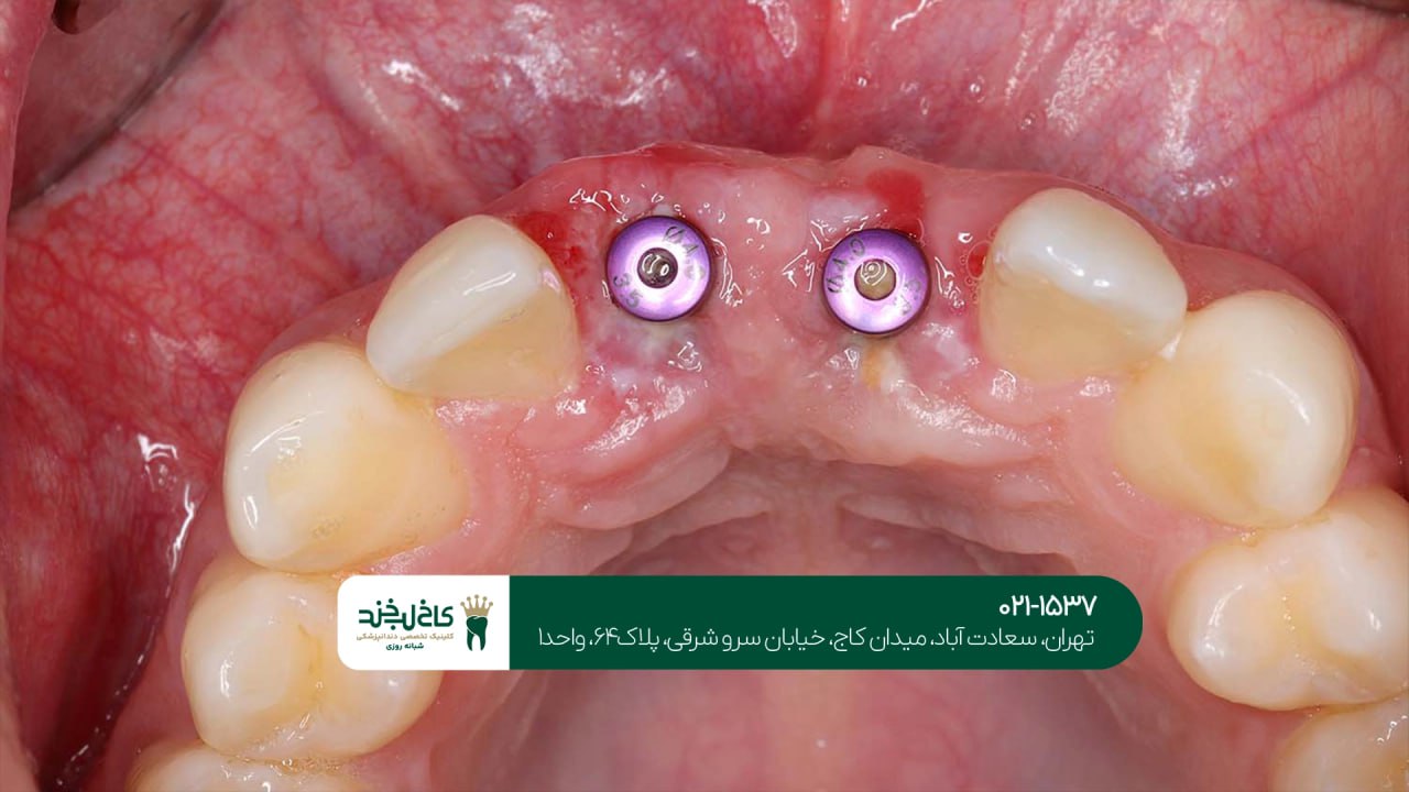 بررسی کیفیت ایمپلنت دندان