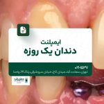 ایمپلنت دندان یک روزه