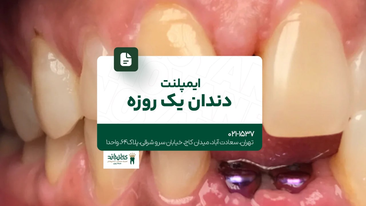 ایمپلنت دندان یک روزه
