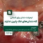 ایمپلنت دندان برای کسانی که دندانهای فک پایین ندارند