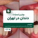 بهترین ایمپلنت دندان در تهران