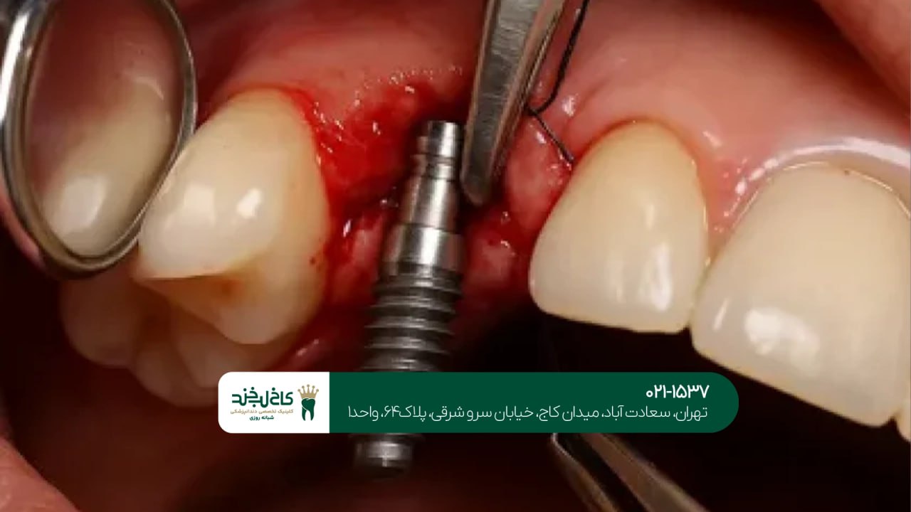 مشاوره ایمپلنت دندان