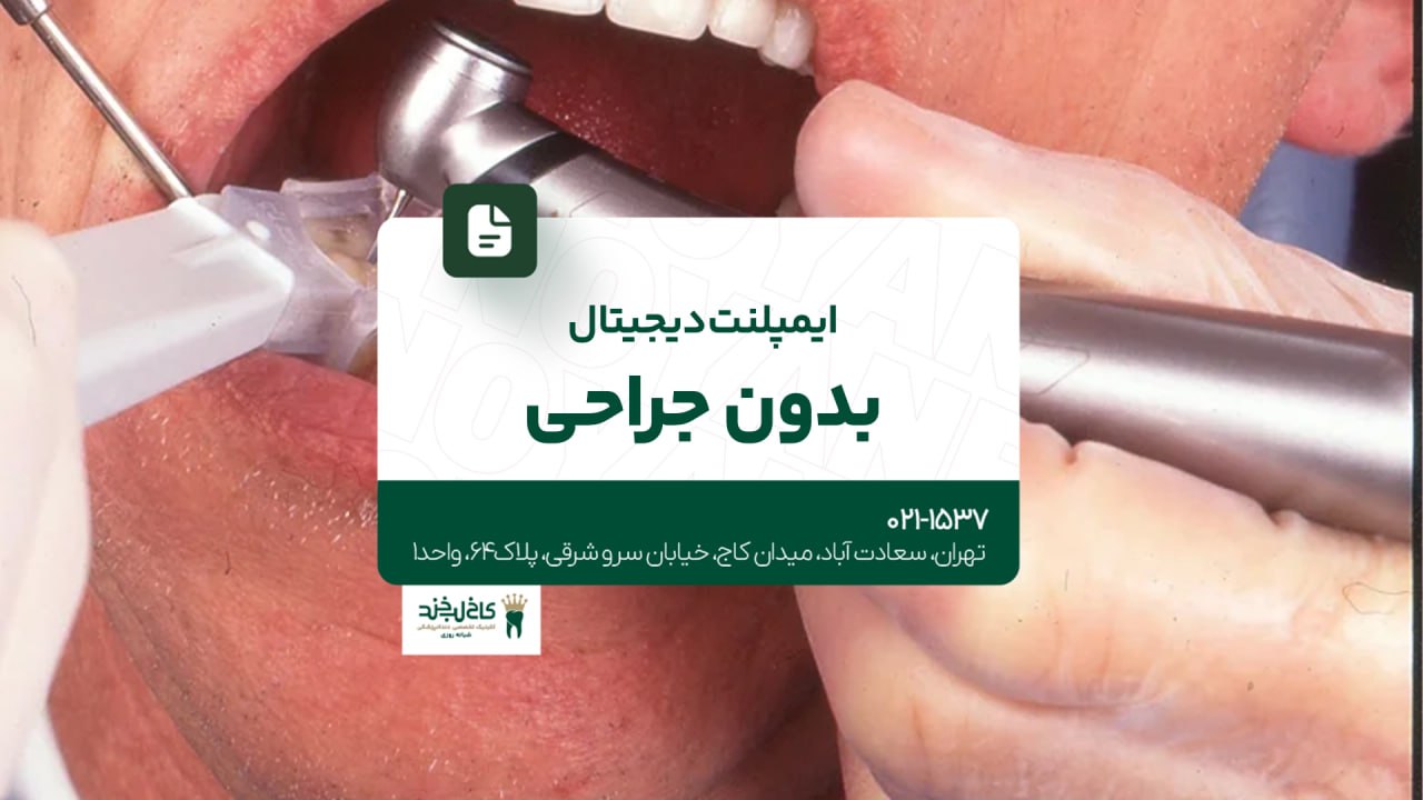 ایمپلنت دیجیتال بدون جراحی ایمپلنت دیجیتال بدون جراحی