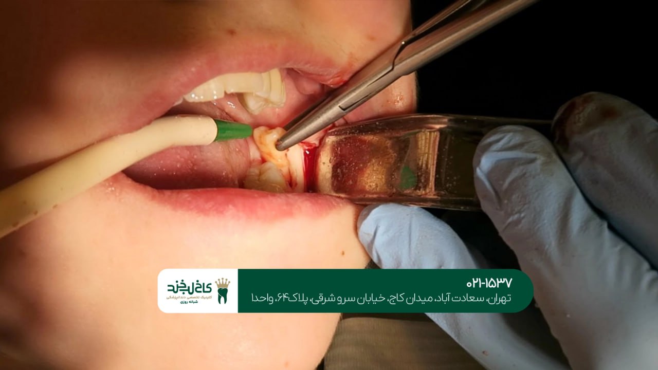 جراحی دندان عقل اقساطی در تهران جراحی دندان عقل اقساطی در تهران