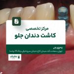 مرکز تخصصی کاشت دندان جلو