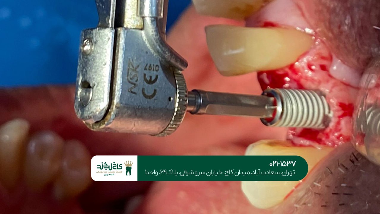 کاشت ایمپلنت در یک جلسه اقساطی کاشت ایمپلنت در یک جلسه اقساطی