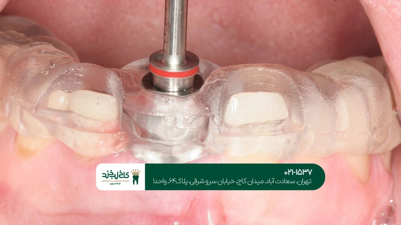 کاشت ایمپلنت در یک جلسه اقساطی کاشت ایمپلنت در یک جلسه اقساطی