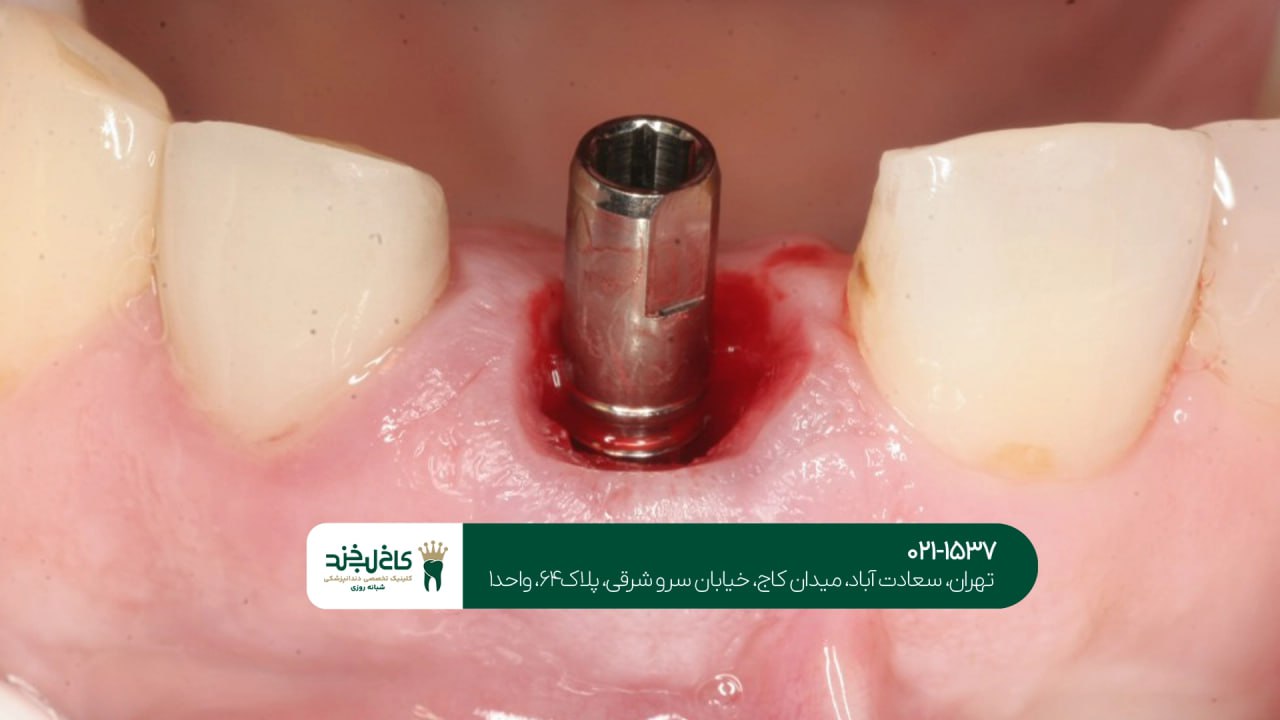 کاشت ایمپلنت در یک جلسه اقساطی کاشت ایمپلنت در یک جلسه اقساطی