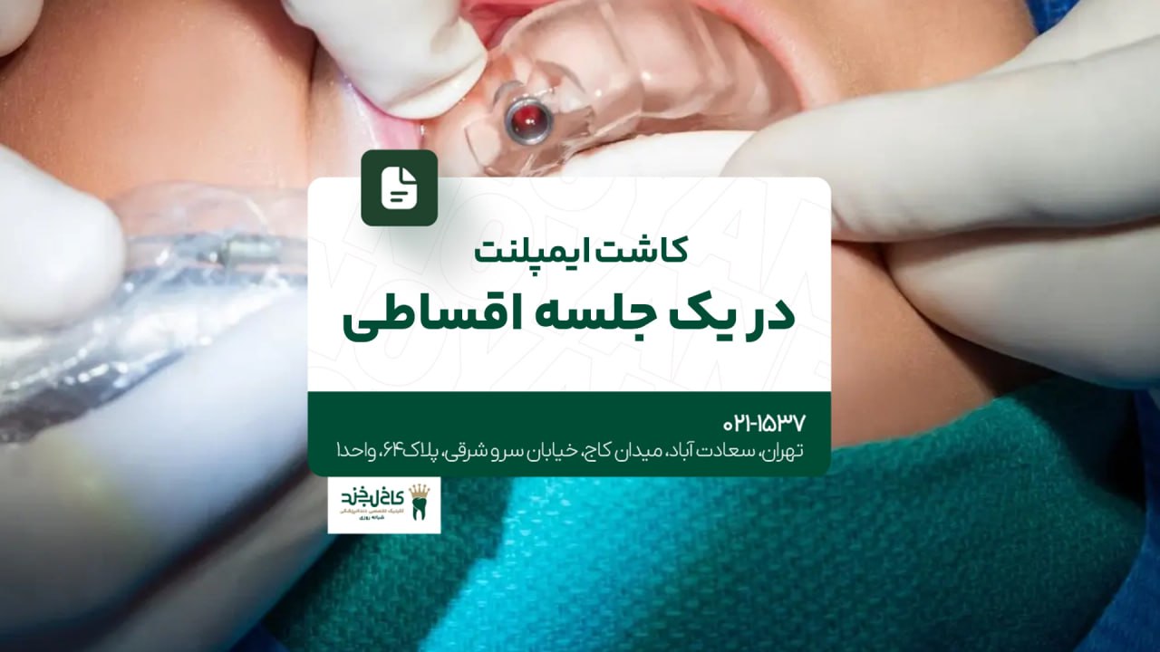 کاشت ایمپلنت در یک جلسه اقساطی کاشت ایمپلنت در یک جلسه اقساطی