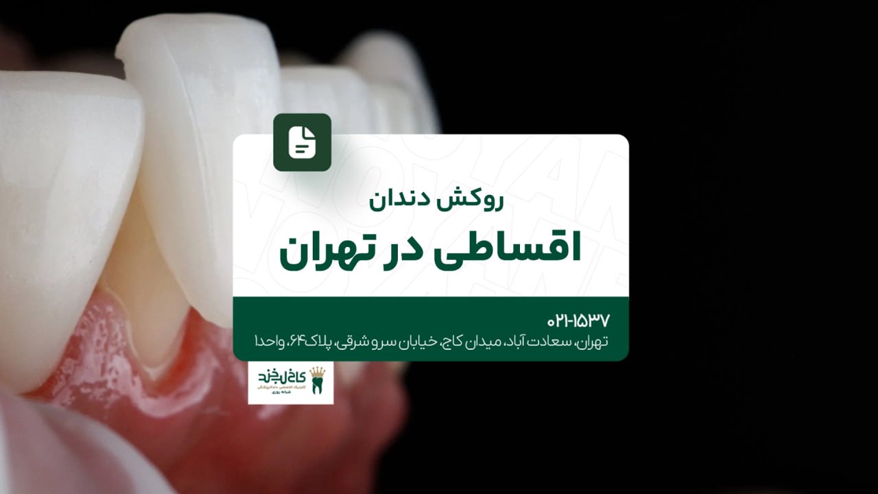 روکش دندان اقساطی در تهران روکش دندان اقساطی در تهران