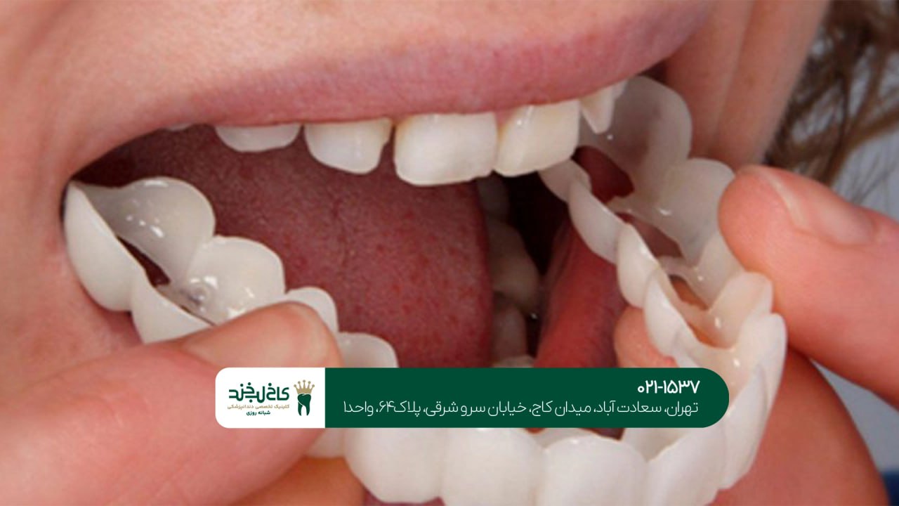 روکش دندان اقساطی در تهران روکش دندان اقساطی در تهران