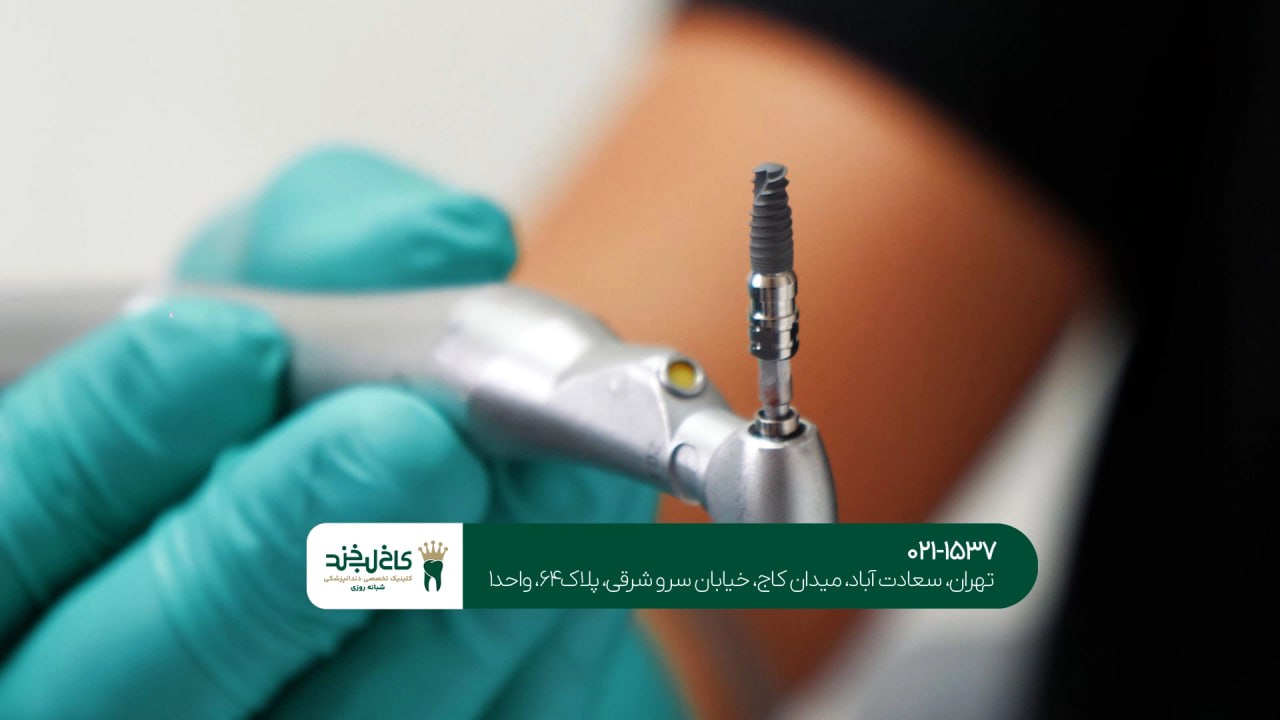 کاشت دندان با لیزر در شمال تهران کاشت دندان با لیزر در شمال تهران