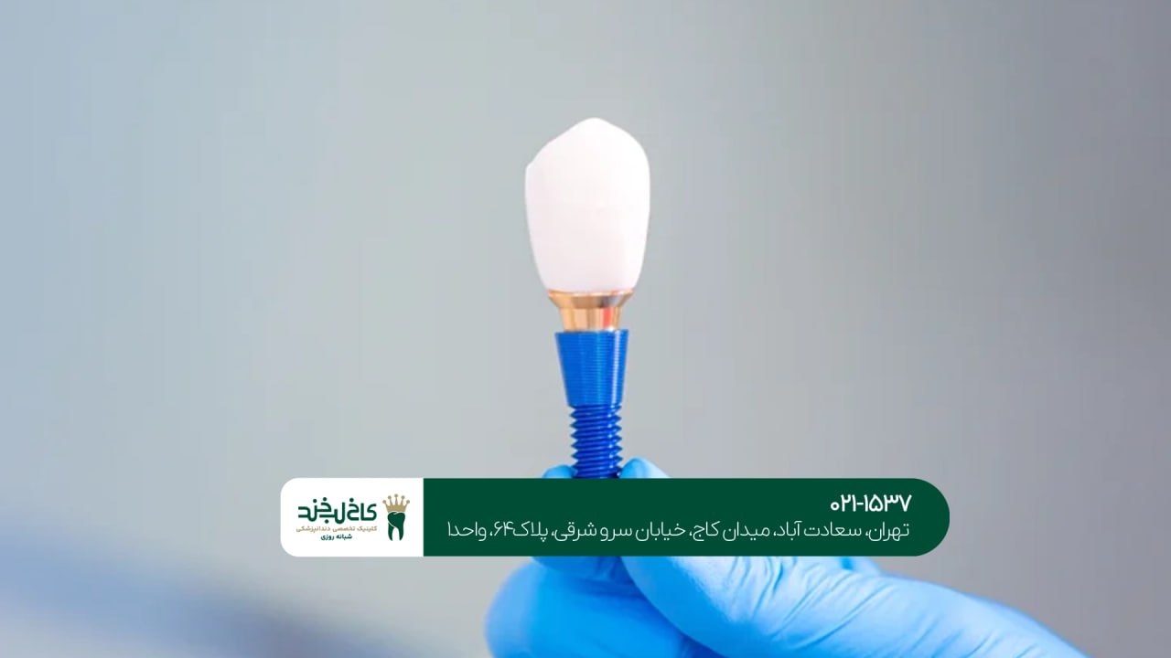 کاشت دندان با لیزر در شمال تهران کاشت دندان با لیزر در شمال تهران